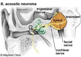 Ảnh 4 của Acoustic Schwannoma